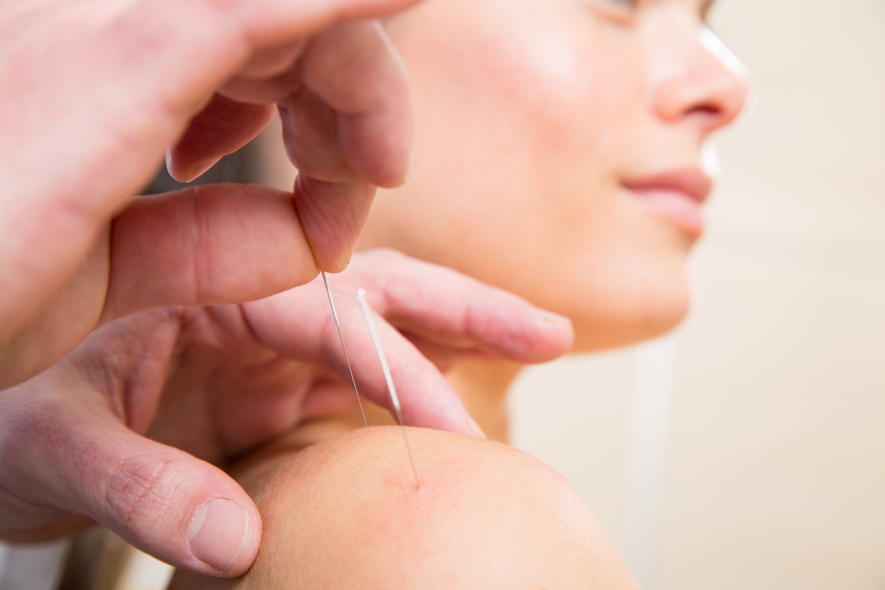 Effektive Stiche – Akupunktur in Sport und Fitness